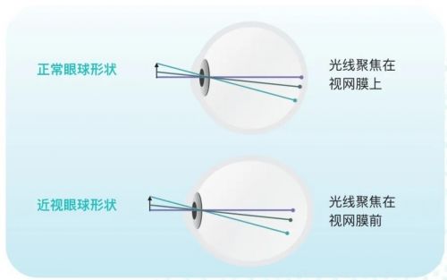 近视眼最新技术，重塑视觉世界的希望之光探索