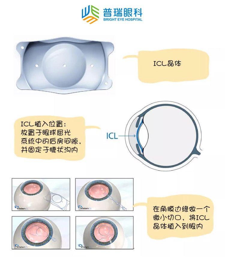 国内ICL晶体V5技术引领视力矫正新时代